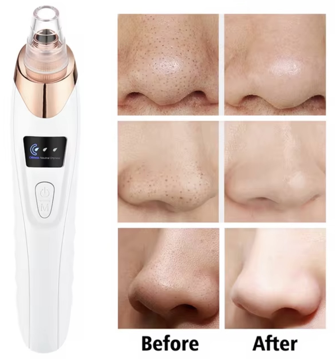 SPECIES Electric Blackhead Remover Vacuum