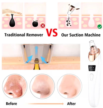 SPECIES Electric Blackhead Remover Vacuum